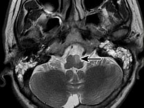 单侧延髓梗死伴发Ondine’s curse综合征 如何阻止死神的随时降临?