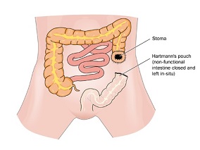 免疫功能正常的肛管癌患者：西妥昔单抗+放化疗治疗效果如何？