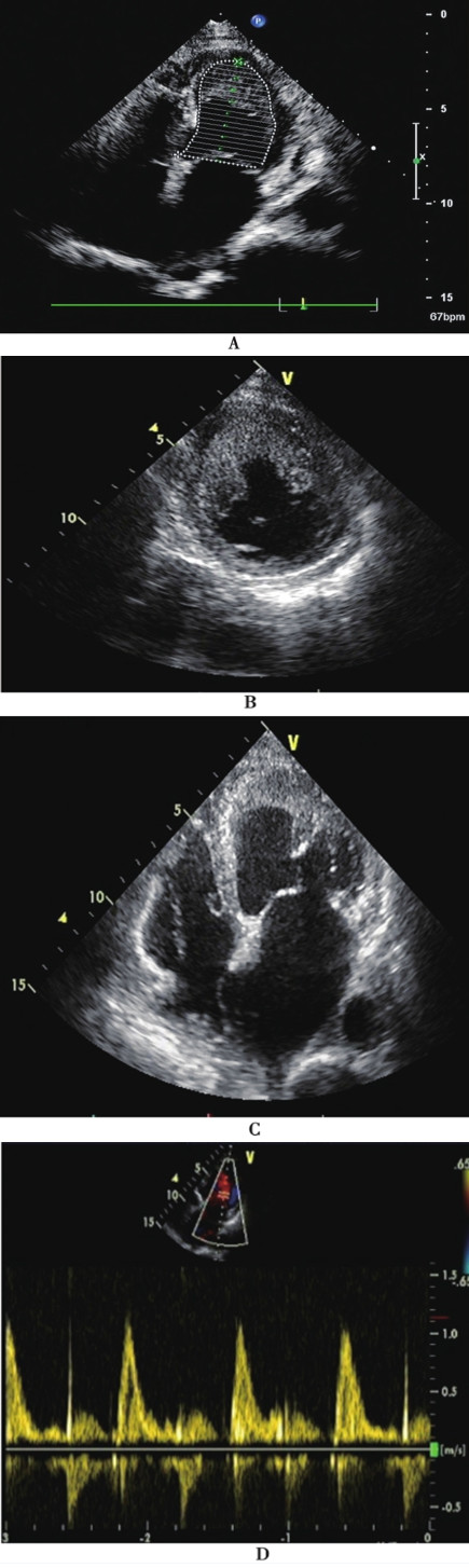 3月22日,超声心动图:左心房前后径41mm,左心室舒张末期内径54mm,左