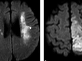 39岁男性突发肢体无力 三维对比增强磁共振血管成像找到病因