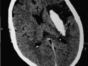 祸不单行!脑出血后溺水如何应对?