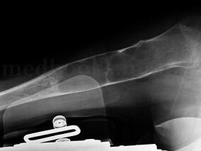 跌倒后右上臂疼痛 除了骨折还有……