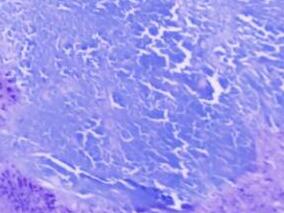 左肘肿物逐渐增大 不可轻视