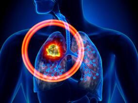 埃罗替尼联合贝伐单抗可为NSCLC患者提供更多生存获益