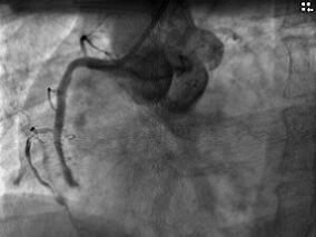 急性心梗给予紧急介入治疗后症状再发 怎么办?