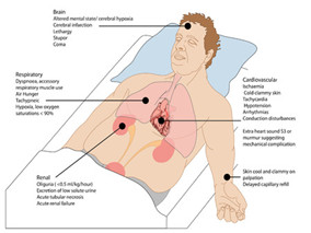 抢救心源性休克 快用主动脉气囊反搏术!