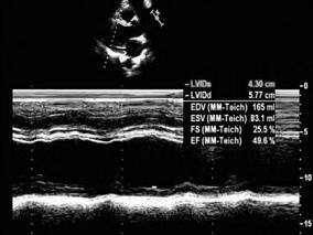 动脉导管未闭术后阵发性心悸 超声心动图查明缘由