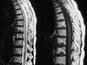 主动脉夹层介入治疗 旧疾刚愈又添新愁