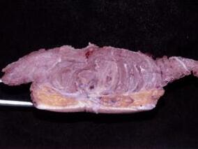 横纹肌肉瘤两次手术后均复发 怎么办?