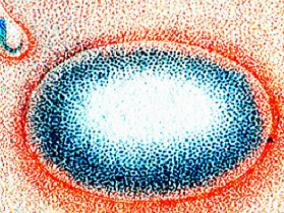 大疱性类天疱疮：多西环素PK泼尼松龙