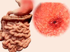 年轻和中年结肠癌患者：过度使用化疗但没有多获益