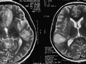 年轻少女因头痛丧命 谁是夺命真凶?