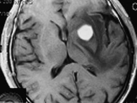 历时3年3次脑活检才确诊该病!