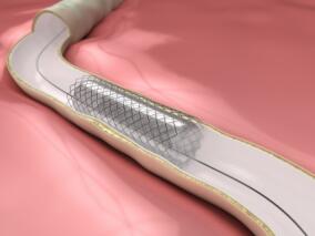 生物可吸收支架是否真的不负众望改善患者结局？