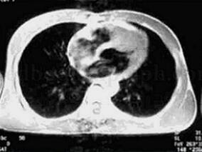 心悸、胸闷原因不明 确诊还需超声心动图