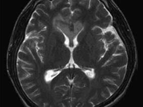罕见!以神经根为首发症状的脑胶质瘤脊神经根播散种植1例