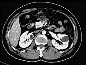 上腹疼痛 除了胰腺炎 还有这个发生率低的病