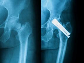 注意！PPI与多个部位的骨折风险增加相关