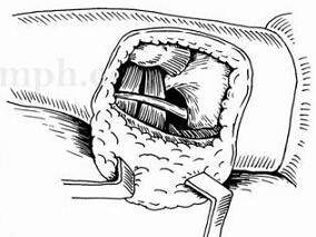 臀部巨大软组织肉瘤 怎么切除是个问题