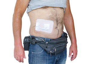 携带心脏植入式电子设备的患者中 利伐沙班是否安全有效?