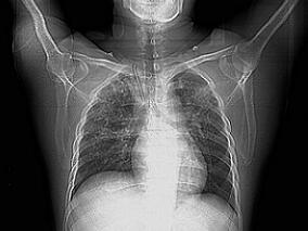 锁骨内固定钢钉脱落损伤主动脉 后果很严重