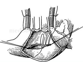 女性幼儿自小发现心脏杂音 何病作祟?