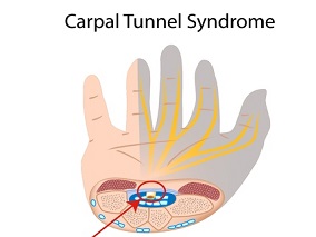 腕管综合征：神经周围注射6个月葡萄糖治疗有效