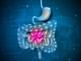他克莫司直肠给药可有效对付难治性溃疡性直肠炎？