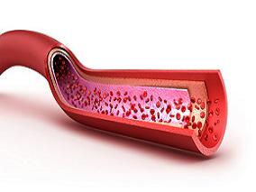 心血管高风险患者应选择ACEIs还是ARBs?