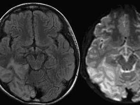 易误诊的线粒体脑肌病MELAS型 您了解多少?
