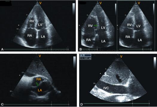 缩窄性心包炎引发循环障碍 鉴别诊断注意什么?