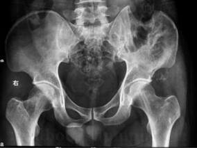 左髂骨软骨肉瘤术后竟两次复发 原来是因为……