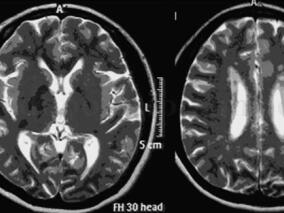 妊娠期间发生肢体麻木无力伴言语不利 是何怪病?