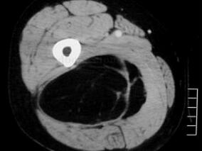 “非典型性脂肪瘤”就不危险吗?