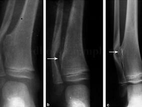 骨软骨瘤术后再发生 原因有点儿“冤”