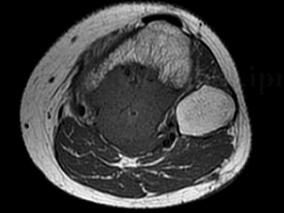 骨巨细胞瘤术后复发 确定病变性质是关键