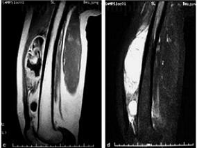 软组织肿物手术后反复发作 手术方式如何抉择？