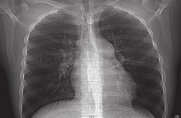 因自身免疫病引起的肺动脉高压 您知道吗?