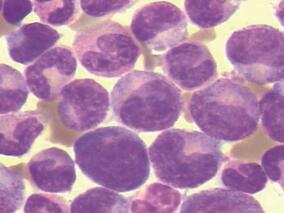 风湿病患者原始细胞比例增高 不一定是白血病!