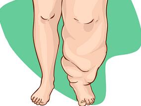 三药治疗淋巴丝虫病惊艳四座