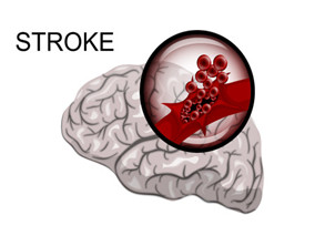 使用标准剂量和低剂量NOAC的AF患者 卒中风险无差异?