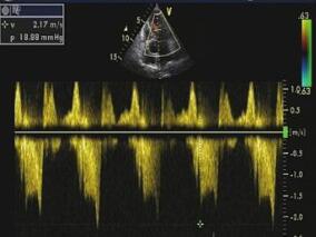 反复晕厥 病因诊断却一再被修改