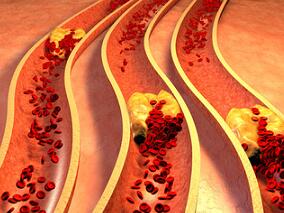 冠脉多支病变患者 替格瑞洛可预防动脉血栓形成吗？