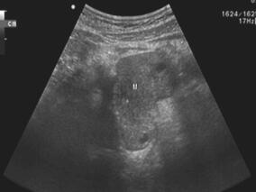 老年患者不慎撞碰腰部 竟被意外发现携带“不定时炸弹”