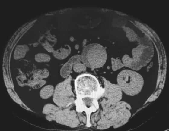 表现为肺水肿 病因却出乎意料