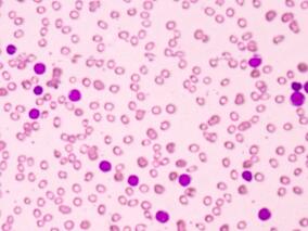 伊布鲁蒂尼治疗慢性淋巴细胞白血病效果如何？