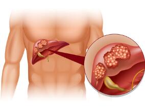 肝硬化误诊为肝癌 险酿大错
