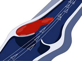 DVT/PE:DOACs的优越性再添一项 ICH显著降低