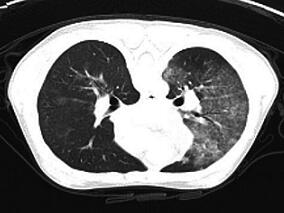 咳血、贫血、肺浸润有点像肺结核 实际是…