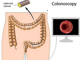 RAS野生型转移性结直肠癌:西妥昔单抗联合FOLFOX-4 vs FOLFOX-4